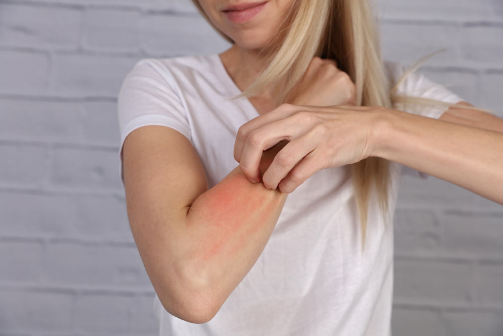 urticaria